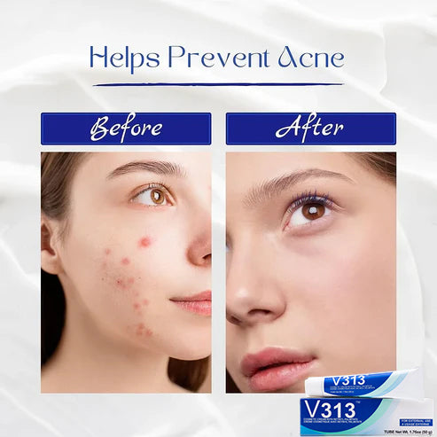 💜Hot Sale 50% OFF🎉V313 - Vitamin A & Retinol Cream
