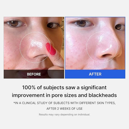 Zero Pore Pads, Dual-Textured Facial Toner Pads for Exfoliation and Pore Care with 4.5% AHA Lactic Acid & 0.45% BHA Salicylic Acid